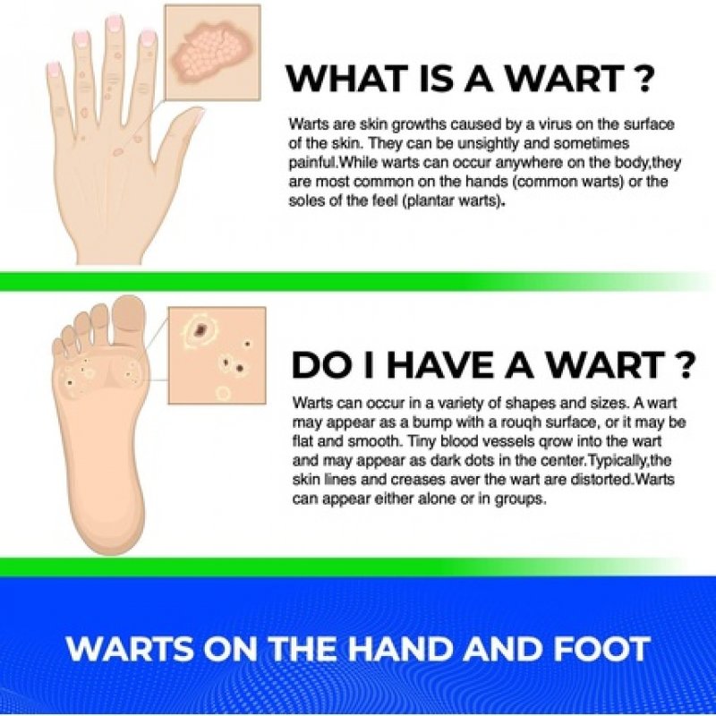Wartix Warts Removal Treatment