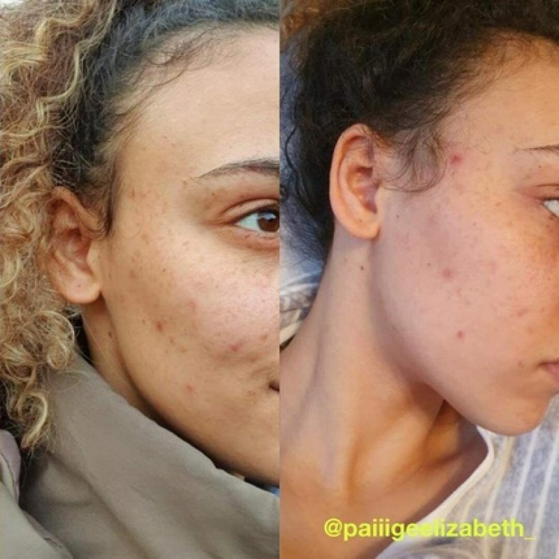 Carbon Theory Tea Tree Oil & Vitamin A Breakout Control 30ml - New