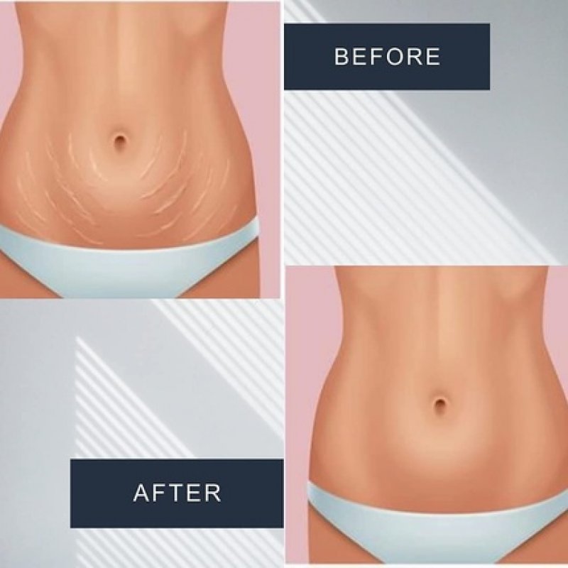 REPAIR Body Care Scar and Stretch Mark Serum 150ml