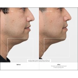 Therabody TheraFace PRO Ultimate Facial Health Device by - White - with conductive gel