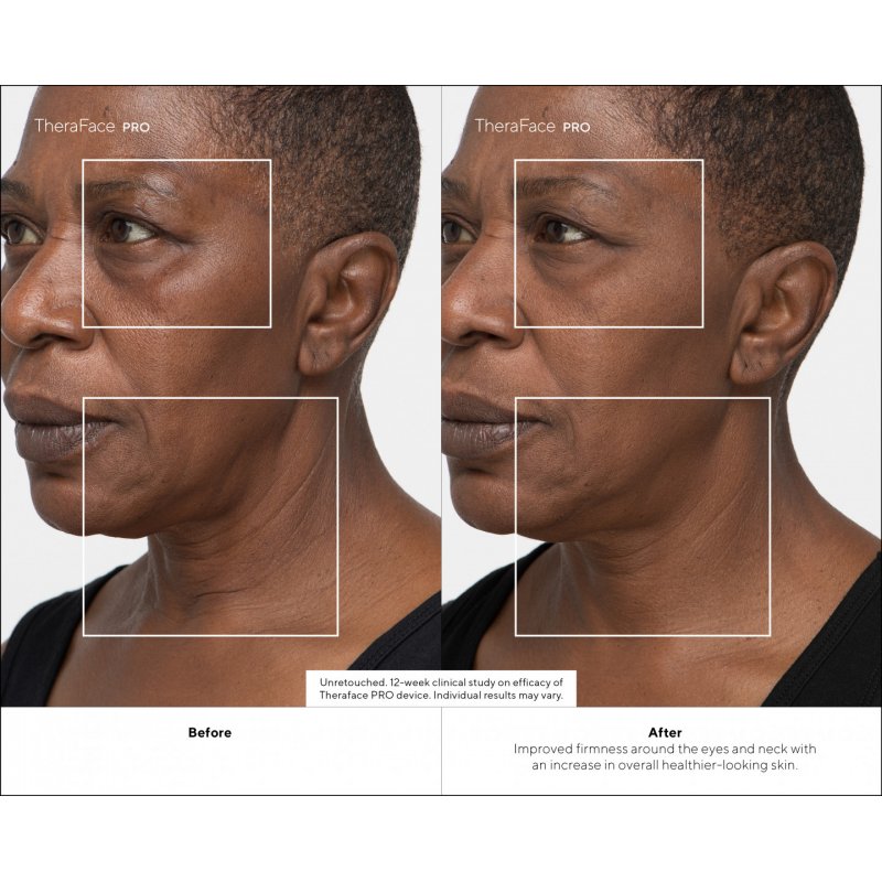 Therabody TheraFace PRO Ultimate Facial Health Device by - White - with conductive gel