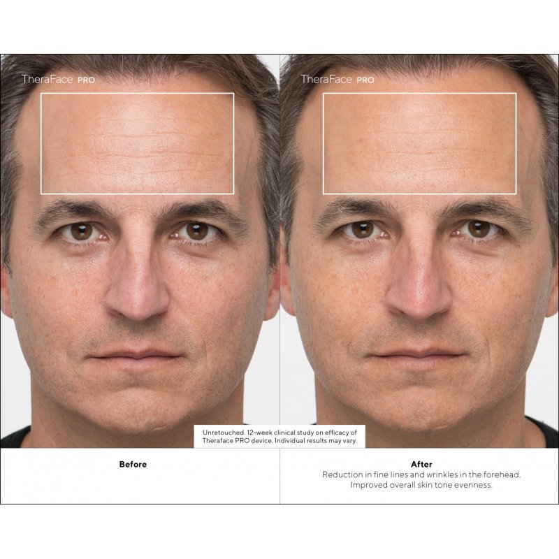 Therabody TheraFace PRO Ultimate Facial Health Device by - White - with conductive gel