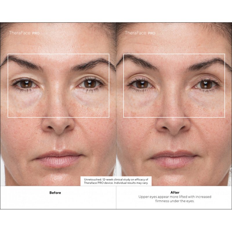 Therabody TheraFace PRO Ultimate Facial Health Device by - White - with conductive gel