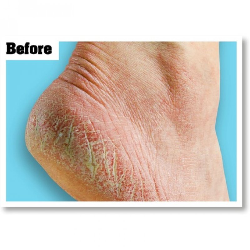 O'Keeffe's Healthy Feet Foot Cream for Extremely Dry Cracked Feet 85g
