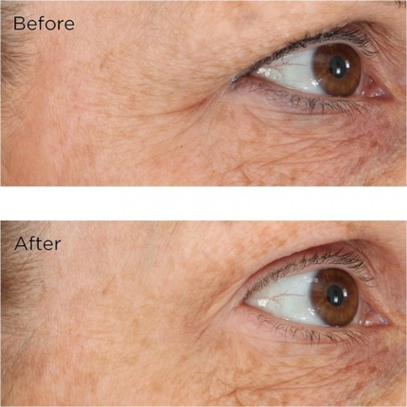 Perricone MD Eyelid Lift Serum