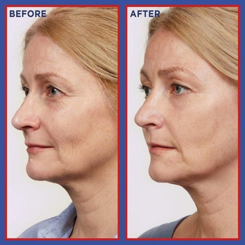 L'Oreal Paris Pure Retinol Night Serum Revitalift Laser Face Serum Deep Anti-Wrinkle Night Serum For Face 30ml