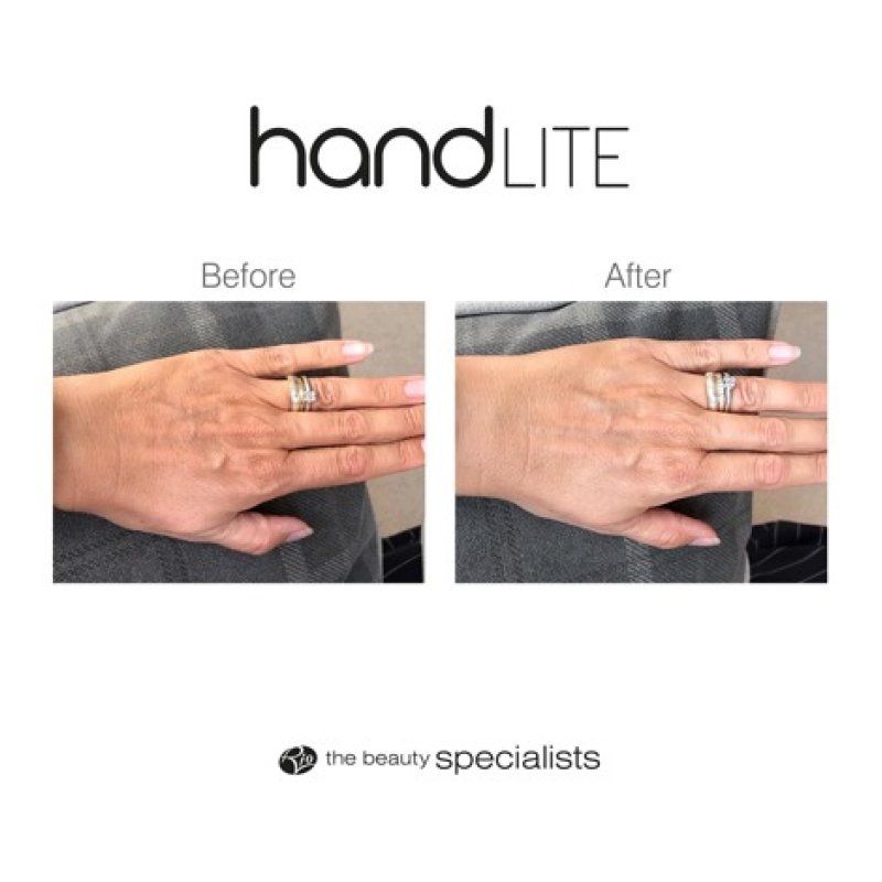 Rio HandLITE skin care appliance Skin light therapy Black, White