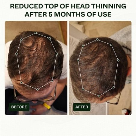 Scandinavian Biolabs Bio-Pilixin Routine for Men - Helps with Hair Shedding