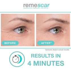 Remescar Crow's Feet Eye Cream Clinically Proven to Reduce Crows Feet Anti-Ageing for Men & Women Filler for Fine Lines