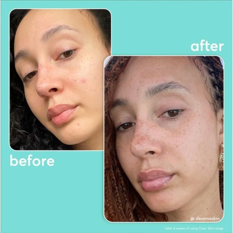 Super Facialist Pore-Fect Daily Moisturiser Hydrate & Control Oil for Acne Treatment & Blackhead Remover with 3%