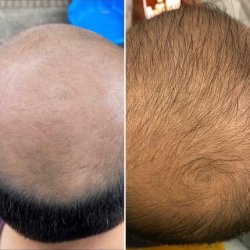 Uraw Blue Serum 100ml Effective Hair Growth Serum