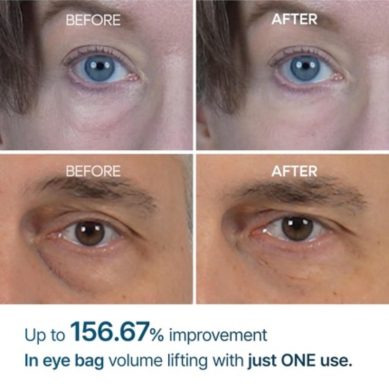 Eyephalt Eyebag Cream for Puffiness, Dark Circles & Fine Lines