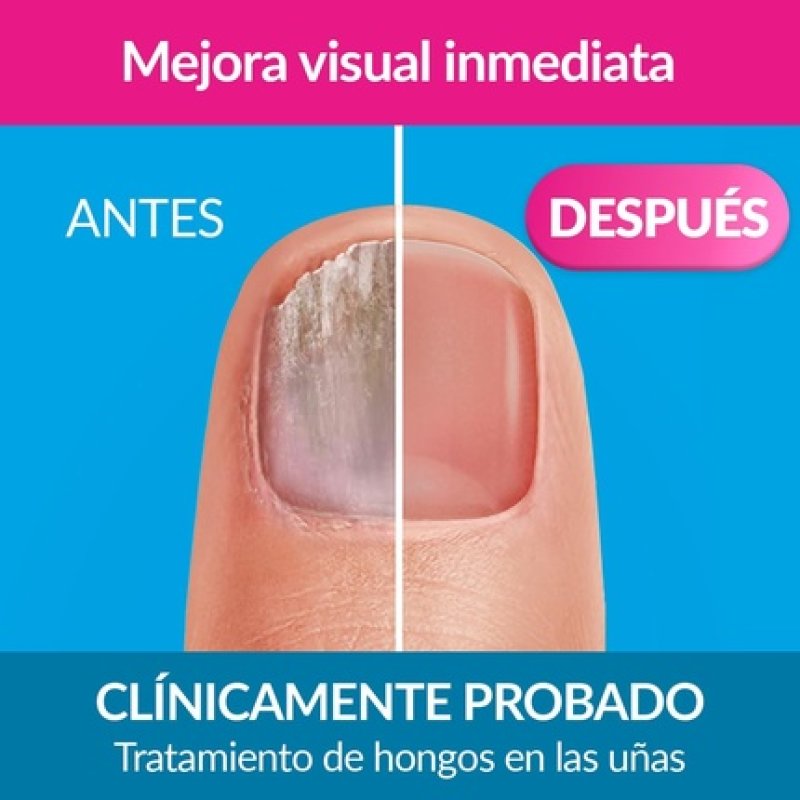 Excilor Nail Fungal Infection Treatment Forte Color Nude