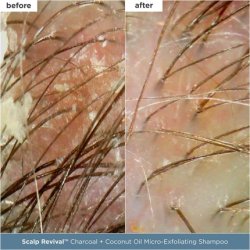 Briogeo Scalp Revival Scalp Care Essentials Set for Dry, Flaky, Itchy Scalp