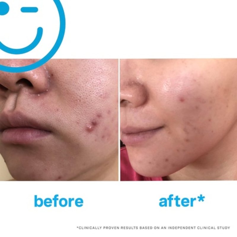 Eradikate 3% Sulfur Daily Foaming Cleanser Acne Treatment