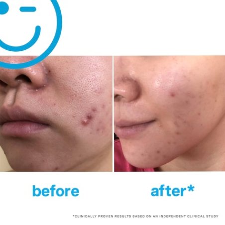 Eradikate 3% Sulfur Daily Foaming Cleanser Acne Treatment