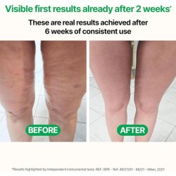 Tesmed Cellulite Manual Patented Anticellulite Massager