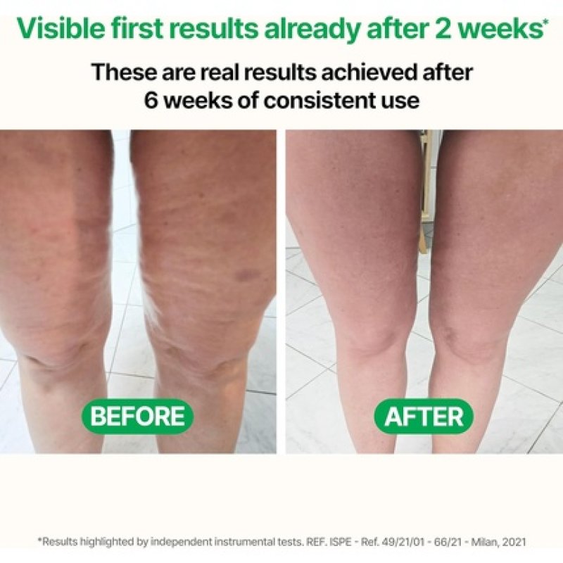 Tesmed Cellulite Manual Patented Anticellulite Massager