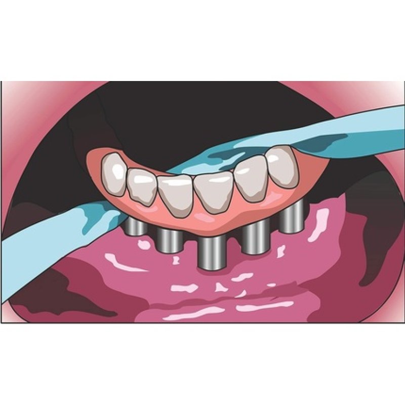 iDontix X-Ribbon Dental Gauze Floss 12m
